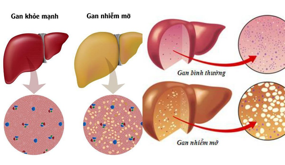 Bỏ quên rau, hảo ngọt: 5 thói quen của người Việt đang tàn phá lá gan không thương tiếc - Ảnh 1.